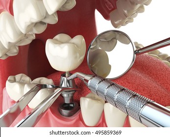 Tooth human implant. Dental implantation concept. Human teeth or dentures anddental tools. 3d illustration