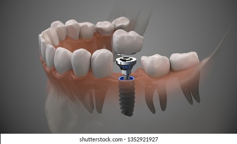 Tooth human implant. On1 concept. Dental prosthetic innovation. 3d illustration.