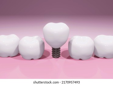 Tooth Human Implants Dental Bridge Tooth Stock Illustration 2170957493