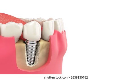 Tooth Human Single Implant Dental Concept Human Teeth Or Dentures  3d Render On White