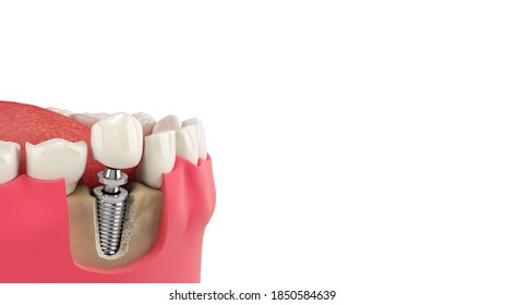 Tooth Human Single Implant Dental Concept Human Teeth Or Dentures  3d Render On White