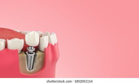 Tooth Human Single Implant Dental Concept Human Teeth Or Dentures  3d Render On Color Gradient