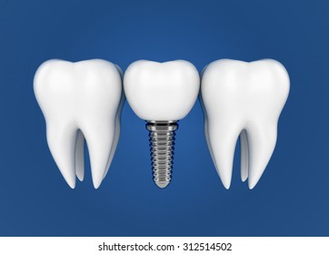 Tooth implant. Dental Concept. 3d illustration