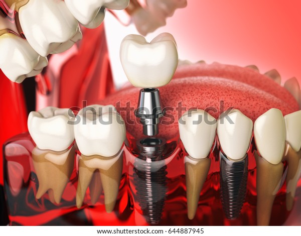 人間の歯 歯茎 デンチュラのモデルに歯を埋め込む 歯科医学の口腔学のコンセプト 3dイラスト のイラスト素材