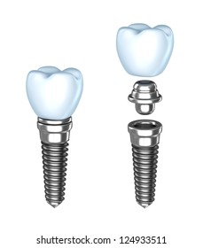 16,755 Dental implant graphic Images, Stock Photos & Vectors | Shutterstock