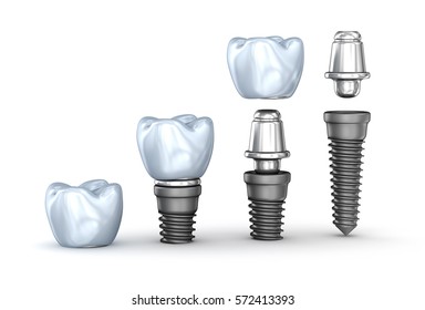 5,499 Titanium implants Images, Stock Photos & Vectors | Shutterstock