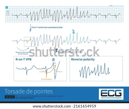 Torsade de pointes is a polymorphic ventricular tachycardia, which occurs in the background of QT interval prolongation. The polarity of the main wave of VT is twisted around the baseline.