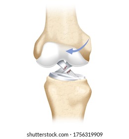 Torsion of femur in extension, causing rupture of the anterior cruciate ligament.