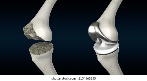 Total Knee Replacement 3D Rendering, Knee Anatomy, Knee Surgery, Osteoarthritis, Prosthesis, Knee Pain, Orthopaedic Surgery, 3D Illustration