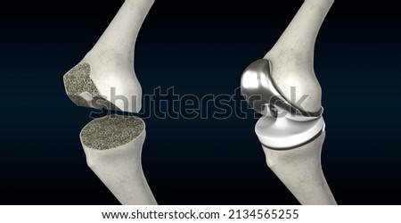 Total Knee Replacement 3D Rendering, Knee Anatomy, Knee Surgery, Osteoarthritis, Prosthesis, Knee Pain, Orthopaedic Surgery, 3D Illustration