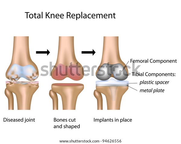 Total Knee Replacement Surgery Stock Illustration 94626556