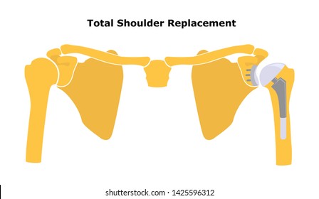 Total Shoulder Replacement. Shoulder Joint Replacement, Endoprosthetics. Osteoarthrosis Of The Shoulder Joint.  Flat Design.