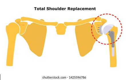 Total Shoulder Replacement. Shoulder Joint Replacement, Endoprosthetics. Osteoarthrosis Of The Shoulder Joint.  Flat Design.