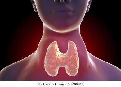 Toxic Diffuse Goiter, Flajani-Basedow-Graves' Disease. 3D Illustration Showing Enlarged Thyroid Gland In A Female With Hyperthyroidism