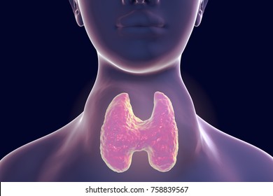 Toxic Diffuse Goiter, Flajani-Basedow-Graves' Disease. 3D Illustration Showing Enlarged Thryoid Gland In A Female With Hyperthyroidism