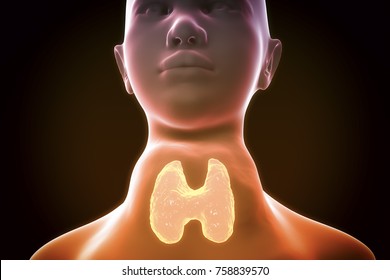 Toxic Diffuse Goiter, Flajani-Basedow-Graves' Disease. 3D Illustration Showing Enlarged Thyroid Gland In A Female With Hyperthyroidism