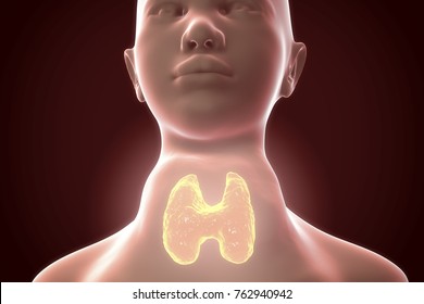 Toxic Diffuse Goiter, Flajani-Basedow-Graves' Disease. 3D Illustration Showing Enlarged Thyroid Gland In A Female With Hyperthyroidism