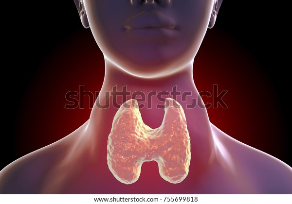 Toxic Diffuse Goiter Flajanibasedowgraves Disease 3d Stock Illustration 755699818 3284