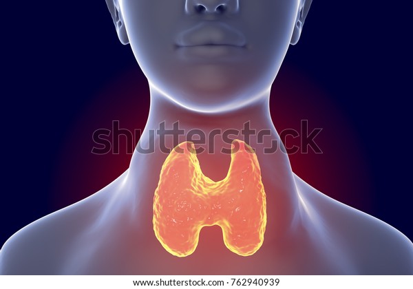 有毒なびまん性甲状腺腫 フラジャニ バセドウ病 甲状腺機能亢進症の女性の肥大した甲状腺を示す3dイラスト のイラスト素材