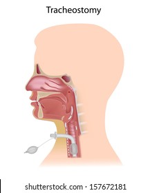 Tracheostomy