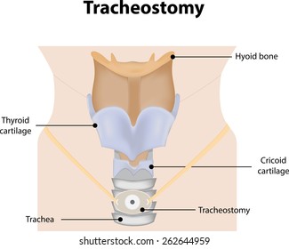 Tracheostomy Labeled Diagram