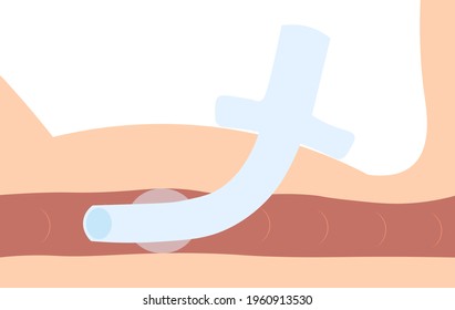 Tracheostomy Tube With Cuff. Trachea Anatomy Side Visualization.