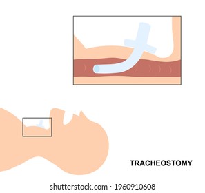 30 Neck stoma Images, Stock Photos & Vectors | Shutterstock