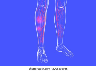 Transparent Anatomical 3d Illustration Of The Human Legs. Showing The Venous System With Varicose Veins And Eczema.