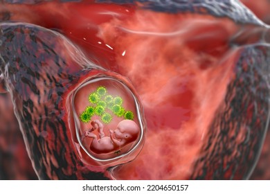 Transplacental Transmission Of Cytomegalovirus (CMV) And Other Viruses To Human Embryo, Conceptual 3D Illustration