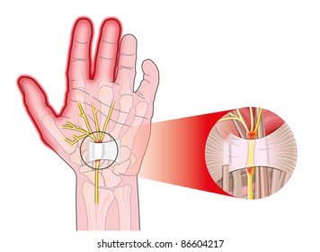 Transverse Carpal Ligament Compressed Median Nerve