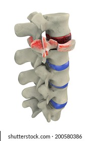 Traumatic Fracture Of Vertebral Burst Fracture 