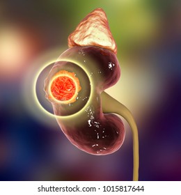 Treatment Of Kidney Cancer, Conceptual Image. 3D Illustration. Kidney Tumour Disease Therapy And Prevention Concept