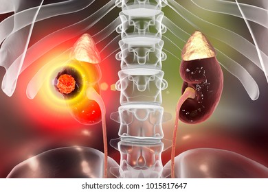 Treatment Of Kidney Cancer, Conceptual Image. 3D Illustration. Kidney Tumour Disease Therapy And Prevention Concept