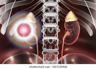 Treatment Of Kidney Cancer, Conceptual Image. 3D Illustration. Kidney Tumour Disease Therapy And Prevention Concept