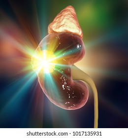 Treatment Of Kidney Cancer, Conceptual Image. 3D Illustration. Kidney Tumour Disease Therapy And Prevention Concept