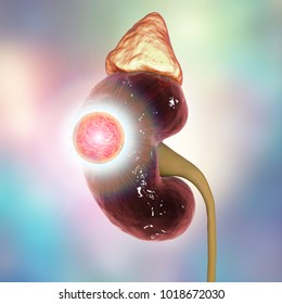 Treatment Of Kidney Cancer, Conceptual Image. 3D Illustration. Kidney Tumour Disease Therapy And Prevention Concept