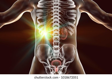 Treatment Of Kidney Cancer, Conceptual Image. 3D Illustration. Kidney Tumour Disease Therapy And Prevention Concept