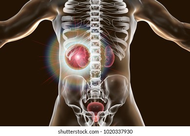 Treatment Of Kidney Cancer, Conceptual Image. 3D Illustration. Kidney Tumour Disease Therapy And Prevention Concept