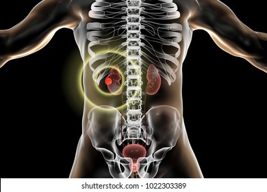 Treatment Of Kidney Cancer, Conceptual Image. 3D Illustration. Kidney Tumour Disease Therapy And Prevention Concept