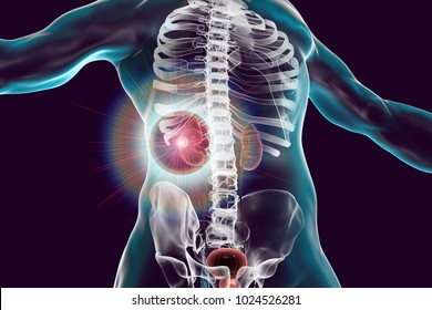 Treatment Of Kidney Cancer, Conceptual Image. 3D Illustration. Kidney Tumour Disease Therapy And Prevention Concept