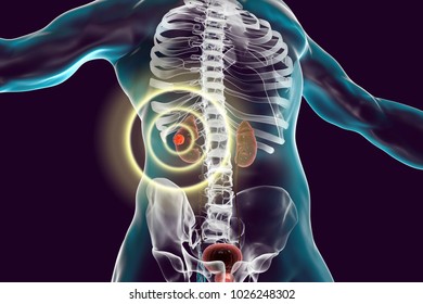 Treatment Of Kidney Cancer, Conceptual Image. 3D Illustration. Kidney Tumour Disease Therapy And Prevention Concept