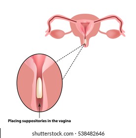 Treatment Of Vaginitis Suppositories Inflammation Of The Vagina Infographics Illustration On Isolated Background Treatment Of Vaginitis Suppositories Inflammation Of The Vagina Infographics Illustration On Isolated Background