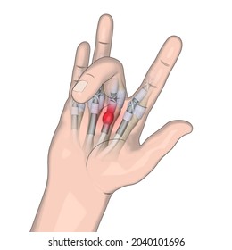 Trigger Finger Illustration, Finger Anatomy, Hand Anatomy, 3D Rendering