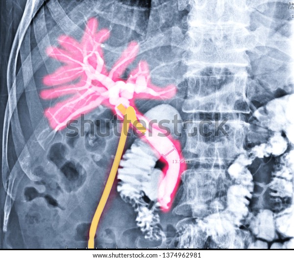 A T-tube cholangiogram is a fluoroscopic\
procedure in which contrast medium is injected through a T-tube\
(Yellow) into the patient\'s biliary\
tree.