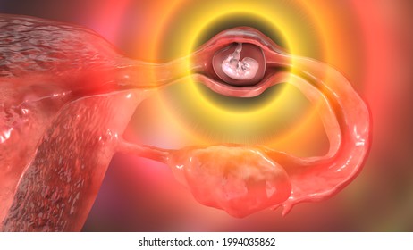 Tubal ectopic pregnancy, 3D illustration showing a 7-week human embryo implanted in the fallopian tube instead of uterus