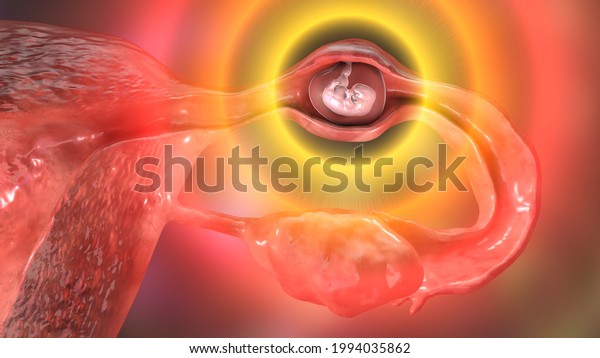 Tubal\
ectopic pregnancy, 3D illustration showing a 7-week human embryo\
implanted in the fallopian tube instead of\
uterus