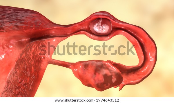 Tubal\
ectopic pregnancy, 3D illustration showing a 7-week human embryo\
implanted in the fallopian tube instead of\
uterus
