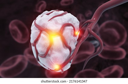 Tumor, Destruction Of A Tumor Cell, Growing Tumor, 3d Illustration