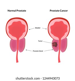 Vector Illustration Cauterization Erosion Before After Stock Vector ...