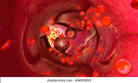 Tumour Cells In Blood Vessels 3d Illustration 